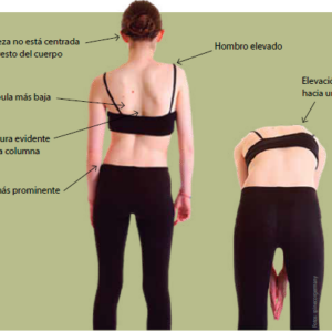 La escoliosis: descripción, causas y síntomas