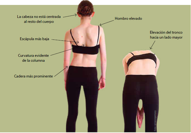 La escoliosis: descripción, causas y síntomas